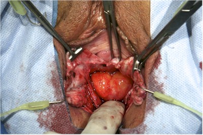 Enterocele