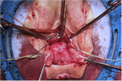 Double Bump Sign of and Rectocele and Enterocele