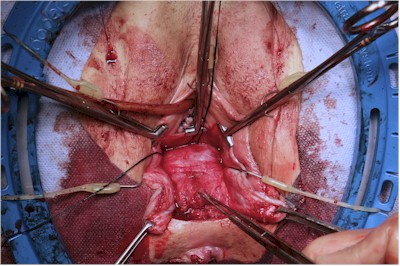 Pointing at the Rectocele