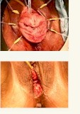 vaginal cosmetic surgery