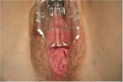 vaginoplasty case 9